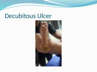 Decubitous Ulcer
 