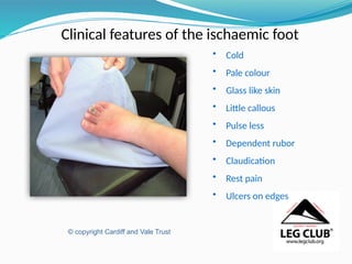 Clinical features of the ischaemic foot
• Cold
• Pale colour
• Glass like skin
• Little callous
• Pulse less
• Dependent rubor
• Claudication
• Rest pain
• Ulcers on edges
© copyright Cardiff and Vale Trust
 
