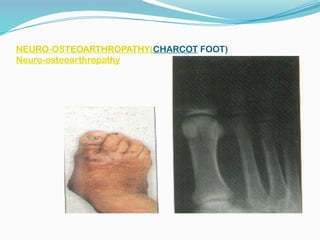 NEURO-OSTEOARTHROPATHY(CHARCOT FOOT)
Neuro-osteoarthropathy
 