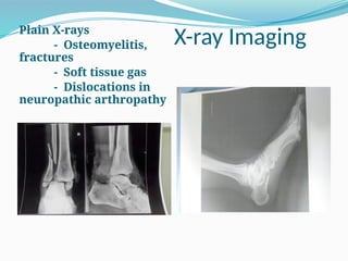 X-ray Imaging
Plain X-rays
- Osteomyelitis,
fractures
- Soft tissue gas
- Dislocations in
neuropathic arthropathy
 