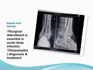 Diabetic Foot
Infection
Surgical
debridment is
essential in
acute deep
infection
Osteomylitis
( diagnoses &
treatment
 