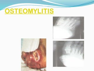 OSTEOMYLITIS
 