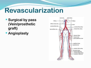 Revascularization
 Surgical by pass
(Vein/prosthetic
graft)
 Angioplasty
 
