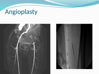 Angioplasty
 