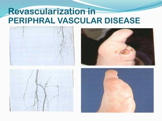 PERIPHRAL VASCULAR DISEASE
Revascularization in
 