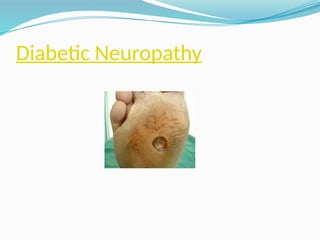 Diabetic Neuropathy
 