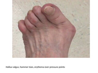 Hallux valgus, hammer toes, erythema over pressure points
 
