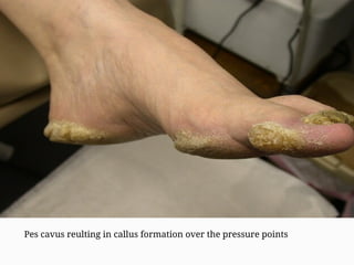 Pes cavus reulting in callus formation over the pressure points
 