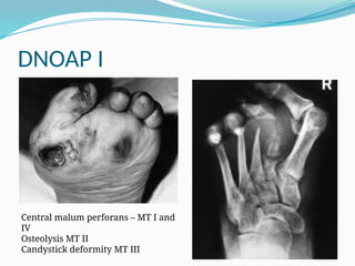 DNOAP I
Central malum perforans – MT I and
IV
Osteolysis MT II
Candystick deformity MT III
 