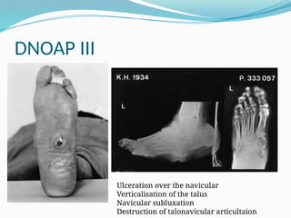 DNOAP III
Ulceration over the navicular
Verticalisation of the talus
Navicular subluxation
Destruction of talonavicular articultaion
 