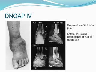 DNOAP IV
Destruction of tibiotalar
joint
Lateral malleolar
prominence at risk of
ulceration
 