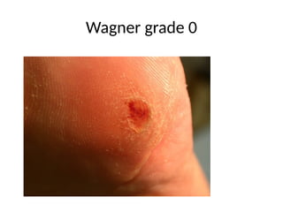 Wagner grade 0
 