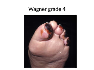 Wagner grade 4
 