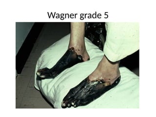 Wagner grade 5
 