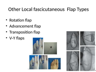 Transposition Vs Rotation Flap diabetic foot its etiopathogenesis and treatment | PPTX