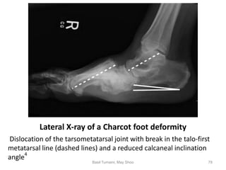 Foot Dashed Line Diabetic foot by Dr. Basil Tumaini and Dr. May Shoo | PPTX
