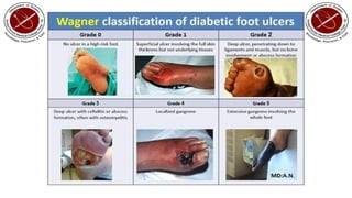 diabetic foot presentation and management | PPTX