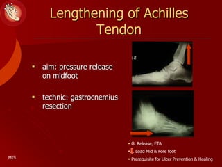 Lengthening of Achilles
Tendon
 aim: pressure release
on midfoot
 technic: gastrocnemius
resection
 G. Release, ETA
 Load Mid & Fore foot
 Prerequisite for Ulcer Prevention & Healing
MIS
 