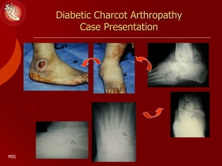 Diabetic Charcot Arthropathy
Case Presentation
MIS
 