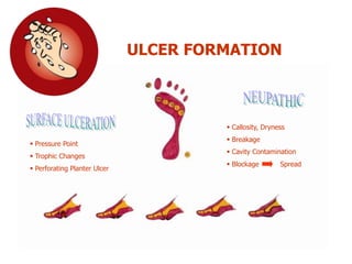 ULCER FORMATION
 Callosity, Dryness
 Breakage
 Cavity Contamination
 Blockage Spread
 Pressure Point
 Trophic Changes
 Perforating Planter Ulcer
 