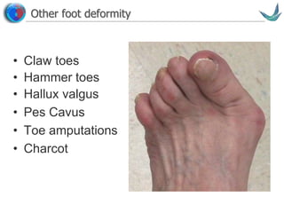 Vascular surgery @ Tallaght
Other foot deformity
• Claw toes
• Hammer toes
• Hallux valgus
• Pes Cavus
• Toe amputations
• Charcot
 