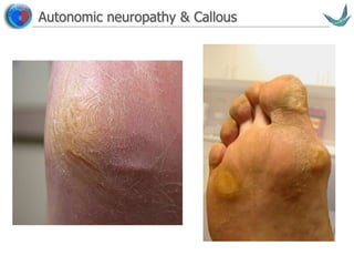 Vascular surgery @ Tallaght
Autonomic neuropathy & Callous
 