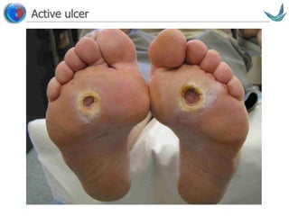 Vascular surgery @ Tallaght
Active ulcer
 