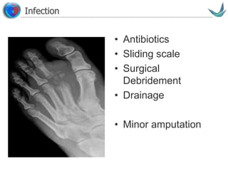 Vascular surgery @ Tallaght
Infection
• Antibiotics
• Sliding scale
• Surgical
Debridement
• Drainage
• Minor amputation
 