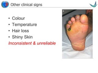 Vascular surgery @ Tallaght
Other clinical signs
• Colour
• Temperature
• Hair loss
• Shiny Skin
Inconsistent & unreliable
 
