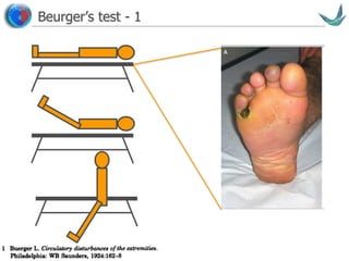 Vascular surgery @ Tallaght
Beurger’s test - 1
 