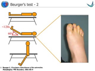 Vascular surgery @ Tallaght
Beurger’s test - 2
60o
<120s
 