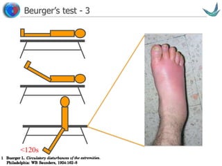Vascular surgery @ Tallaght
Beurger’s test - 3
<120s
 
