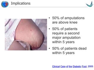 Vascular surgery @ Tallaght
• 50% of amputations
are above knee
• 50% of patients
require a second
major amputation
within 5 years
• 50% of patients dead
within 5 years
Clinical Care of the Diabetic Foot, 2005
Implications
 