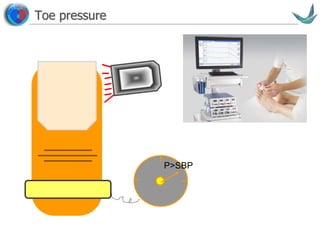 Vascular surgery @ Tallaght
Toe pressure
P>SBP
 
