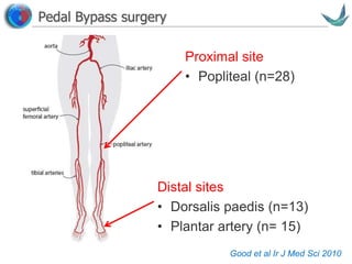 Vascular surgery @ Tallaght
Pedal Bypass surgery
Good et al Ir J Med Sci 2010
Proximal site
• Popliteal (n=28)
Distal sites
• Dorsalis paedis (n=13)
• Plantar artery (n= 15)
 