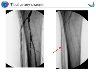 Vascular surgery @ Tallaght
Tibial artery disease
 