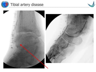 Vascular surgery @ Tallaght
Tibial artery disease
 