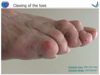 Vascular surgery @ Tallaght
Clawing of the toes
Risk Level
Foot Ulcer
%/yr
% in clinics
(diabetes clinics)
3: Prior amputation
Prior ulcer
28.1%
18.6%
7%
2: Insensate and
foot deformity or
absent pedal
pulses
6.3% 10%
1: Insensate 4.8% 17%-30%
0: All normal 1.7% 66%
Diabetes Care. 2001;24:1442
Diabetes Metab. 2003;29:261
 
