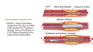 • BASIL-2 Study Finds Better
Amputation-Free Survival With
Endovascular-First Treatment
Strategy Versus Vein Bypass in
CLTI Patients Requiring Infra-
popliteal Revascularization
 