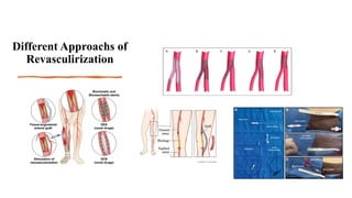 Different Approachs of
Revasculirization
 