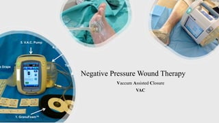 Negative Pressure Wound Therapy
Vaccum Assisted Closure
VAC
 