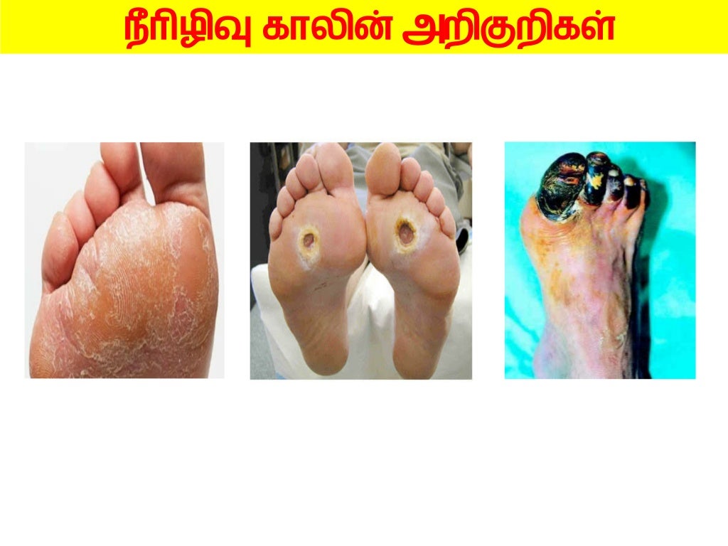 DIABETIC FOOT CARE HEALTH EDUCATION IN TAMIL LANGUAGE