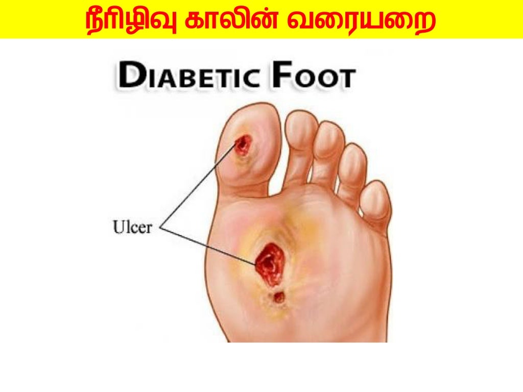 DIABETIC FOOT CARE HEALTH EDUCATION IN TAMIL LANGUAGE