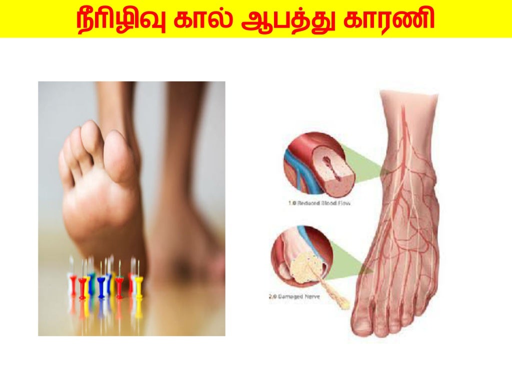 DIABETIC FOOT CARE HEALTH EDUCATION IN TAMIL LANGUAGE