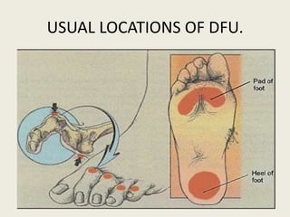 Dfu Management Diabetic foot disease | PPTX