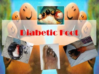 Diabetic Foot 