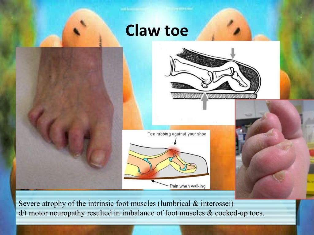 Diabetic foot + gangrene