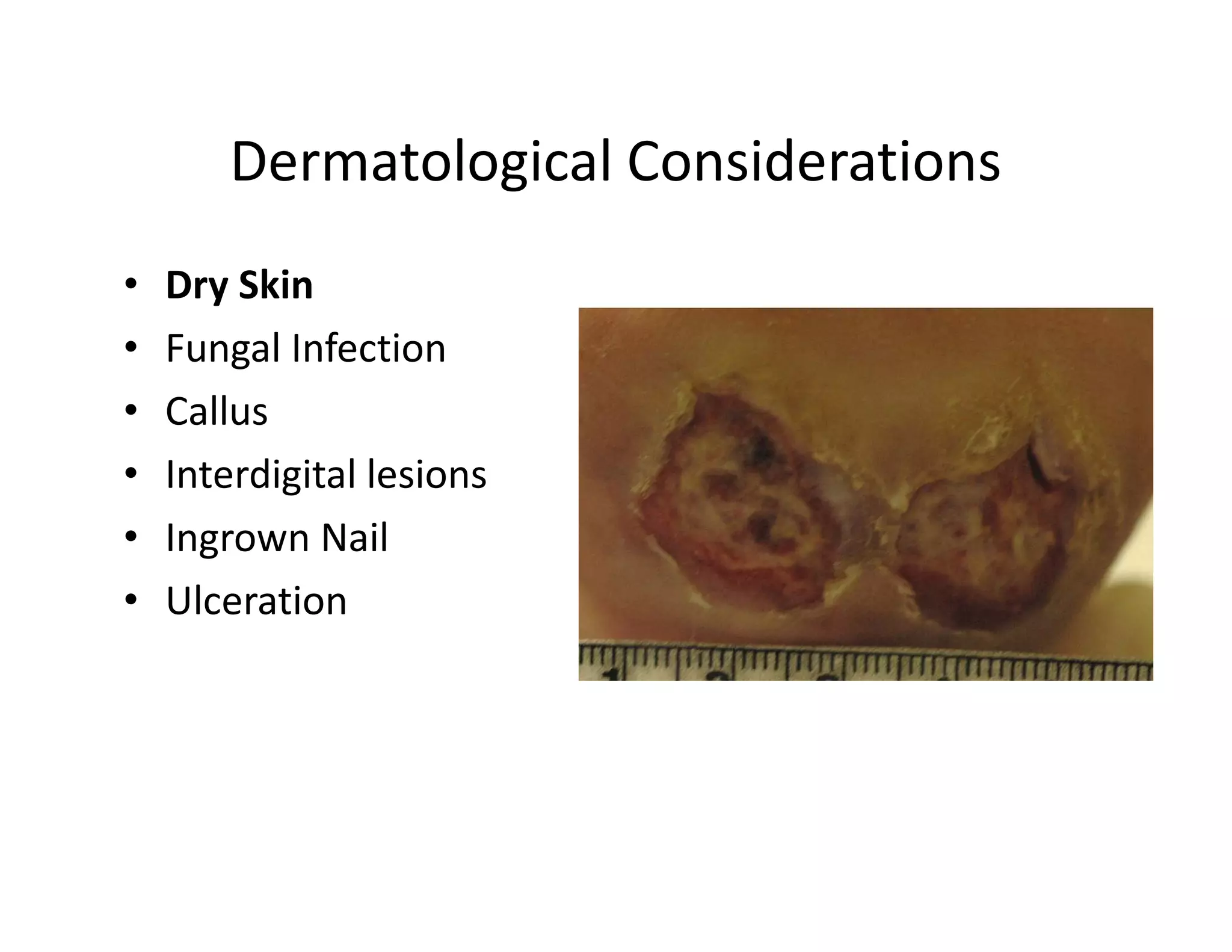 Dermatological Considerations
•   Dry Skin
•   Fungal Infection
•   Callus
•   Interdigital lesions
•   Ingrown Nail
•   Ulceration
 
