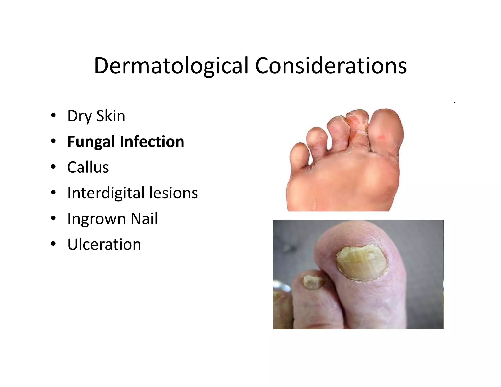 Dermatological Considerations
•   Dry Skin
•   Fungal Infection
•   Callus
•   Interdigital lesions
•   Ingrown Nail
•   Ulceration
 
