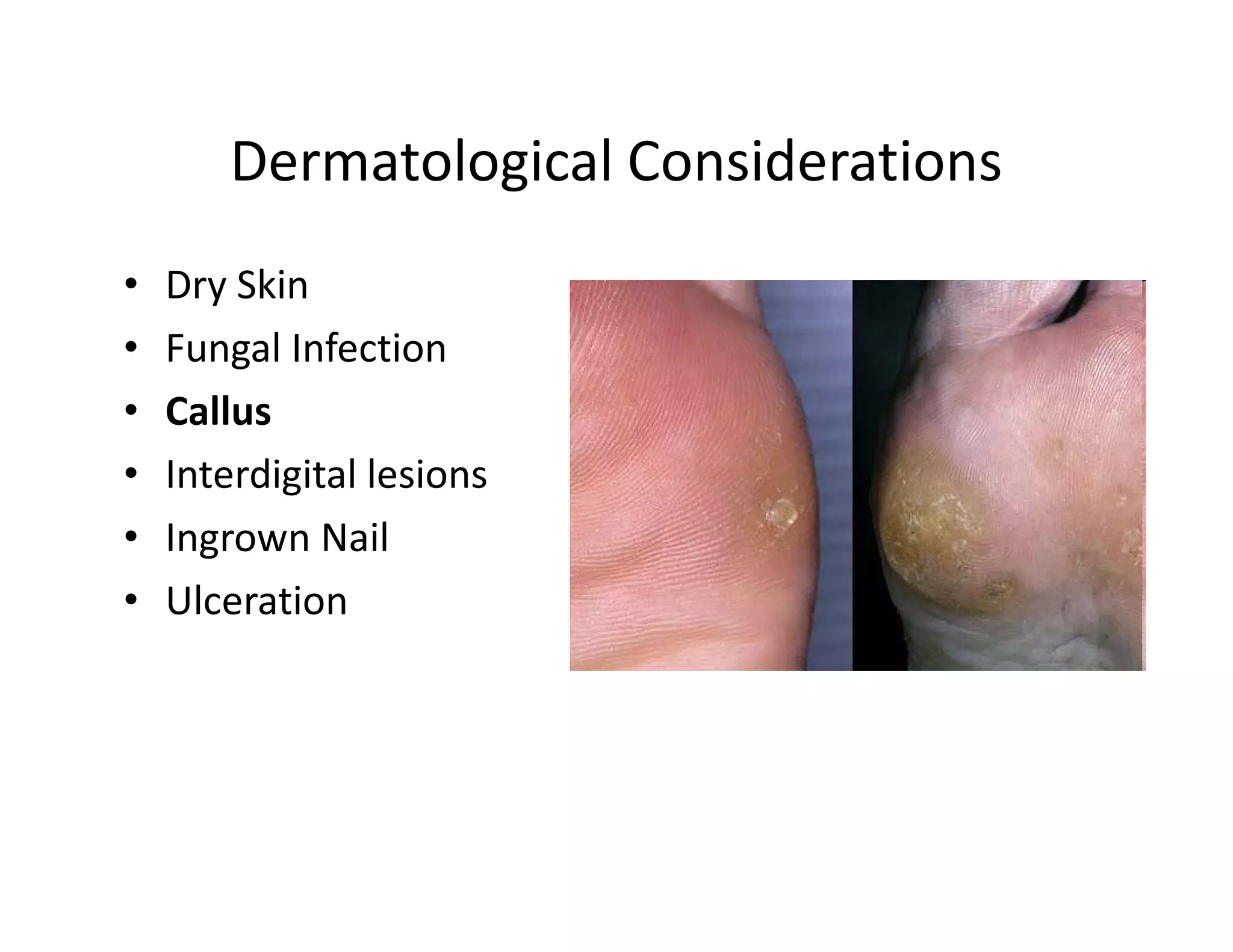 Dermatological Considerations
•   Dry Skin
•   Fungal Infection
•   Callus
•   Interdigital lesions
•   Ingrown Nail
•   Ulceration
 